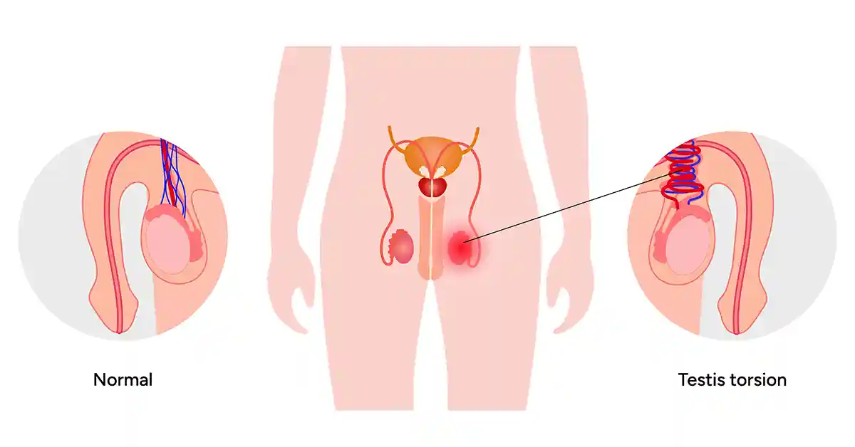 Testis Torsiyonu: Acil Belirtiler, Tanı ve Tedavi
