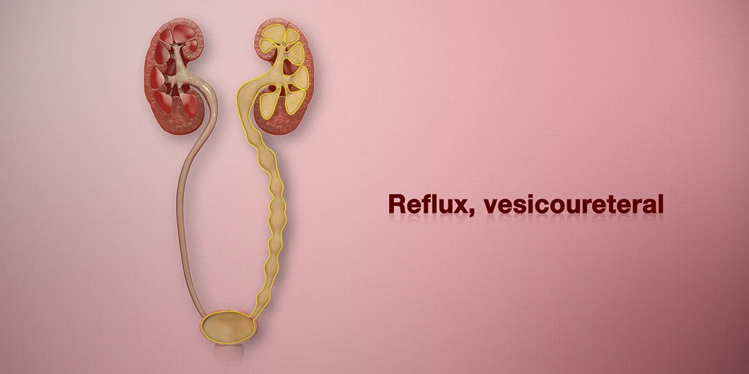  Vezikoüreteral Reflü Nedir, Nasıl Tedavi Edilir? 