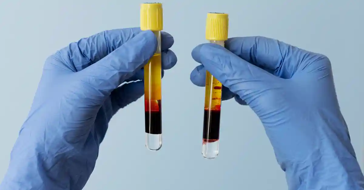 İdrarda Kan (Hematüri): Nedenleri, Tanısı ve Tedavi Yöntemleri