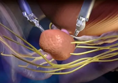 Radikal Prostatektomi Ameliyatı