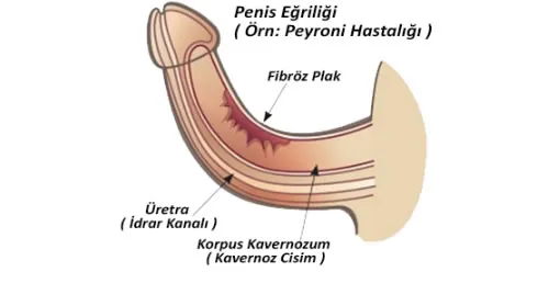 Penil Kurvatür (Peniste Eğrilik)