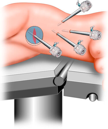 Laparoskopik (Kapalı) böbrek ameliyatı nedir? Nasıl yapılır?