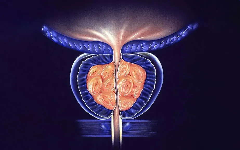 Prostatit türleri ve kronik prostatit tedavi seçenekleri