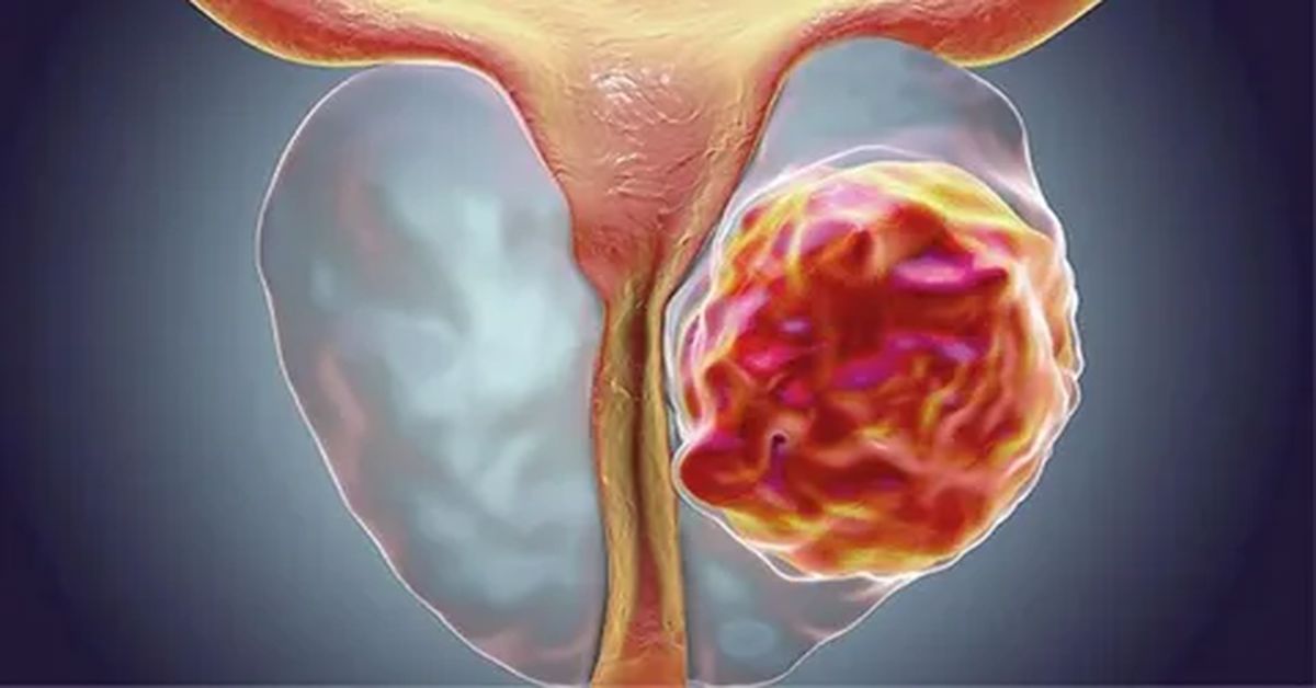 Prostat Kanseri Takip Protokolleri: Hangi Sıklıkla Kontrol Edilir?